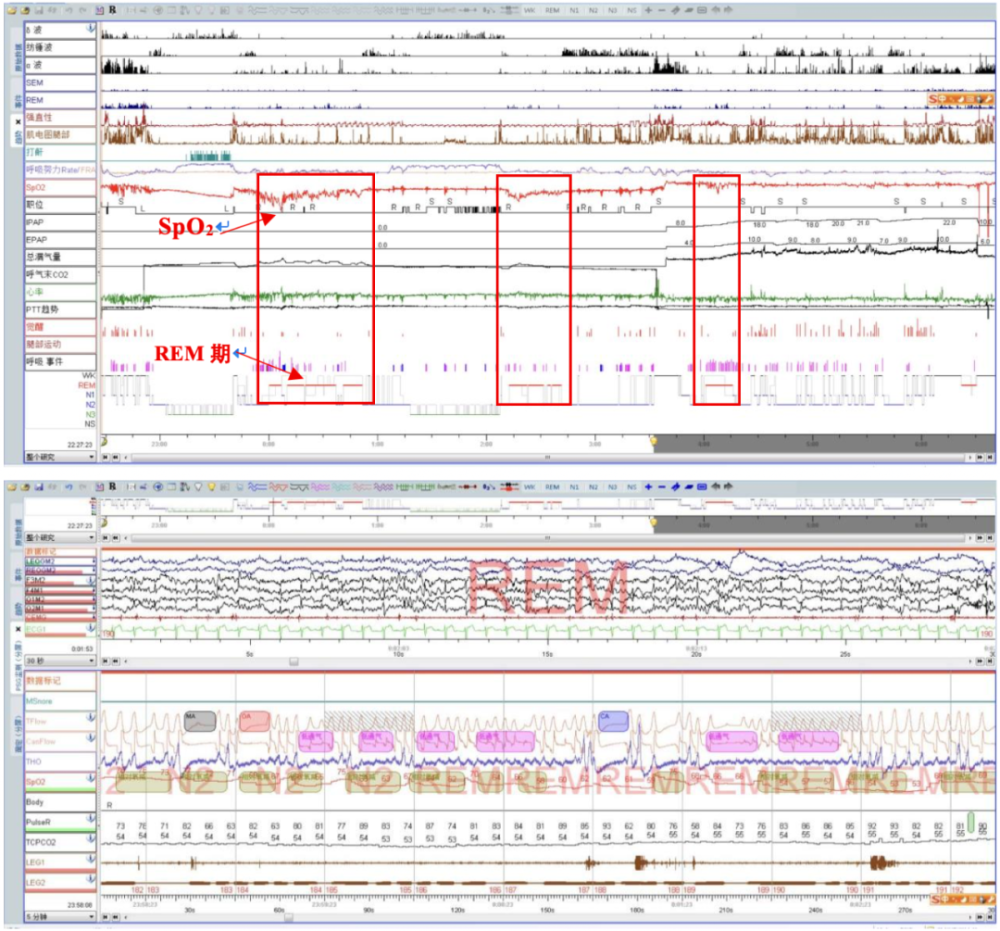 呼吸机怎么打开Ⅱ型呼吸衰竭又陷诊断困局……当室速撞上呼吸“牢笼”，如何通过破解隐匿的神经肌肉密码打开思路，拨云见日？丨疑案探密（161）_https://www.jmylbn.com_新闻资讯_第2张