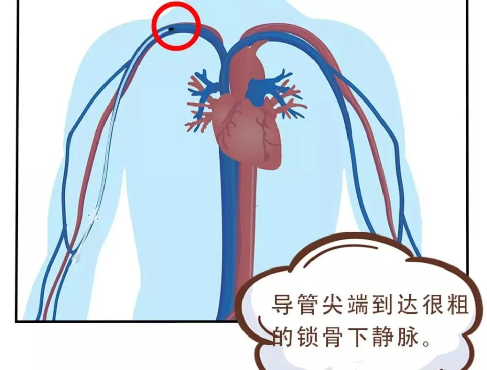 中长导管图片高清图图片