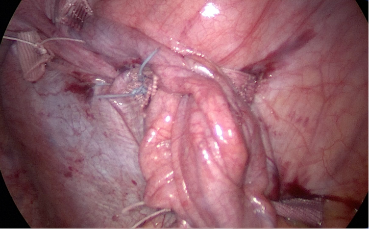 上海哪里买呼吸机好为何肺炎治好了，呼吸机却始终撤不掉？61岁阿姨ICU救治数月，左肺几乎无法正常工作，多学科协作如何“微创”破局？_https://www.jmylbn.com_新闻资讯_第1张