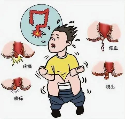 有些痔疮是擦屁股擦出来的!正确排便,便后清洁很重要!