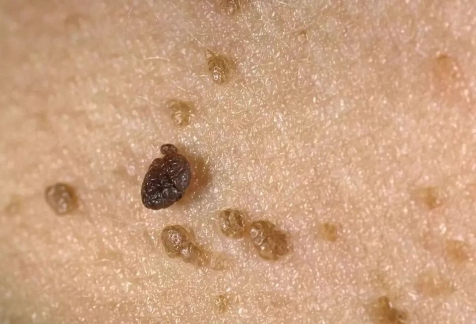脖子上长这种小肉粒,不是普通皮肤病,可能感染了hpv!