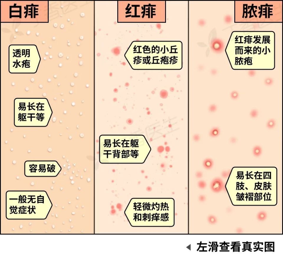 皮肤病种类对照图片