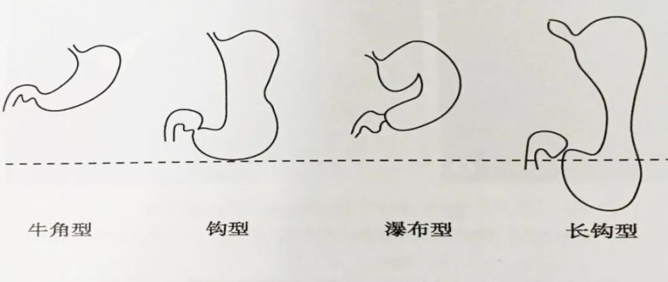 胃也有高矮胖瘦瀑布型胃你了解多少