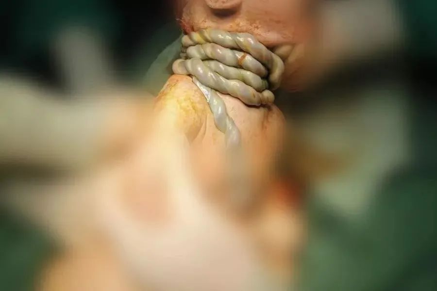 脐带缠绕较松时,对脐血流循环影响小,尚不会危及胎儿,若脐带缠绕过紧
