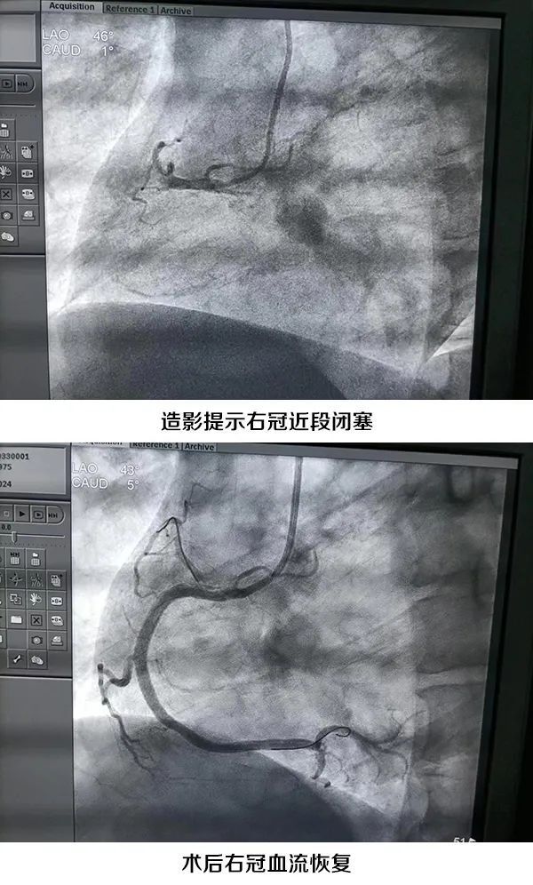 岳西县医院成功抢救一急性心肌梗死患者