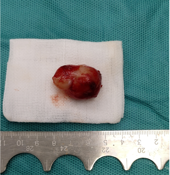 他强调:"许多患者对眼眶肿瘤缺乏重视,认为轻度