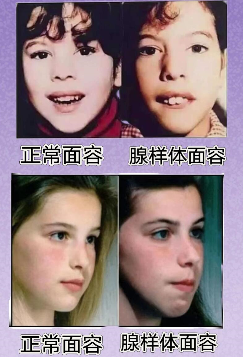 孩子的腺样体,扁桃体,割还是不割?
