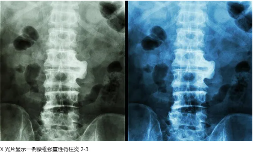 强直性脊柱炎:5 种不寻常的强直性脊柱炎症状