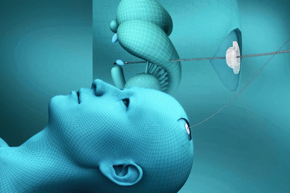 "在景昱医疗总工程师朱为然的表述中,脑机接口的产品之一——神经刺激