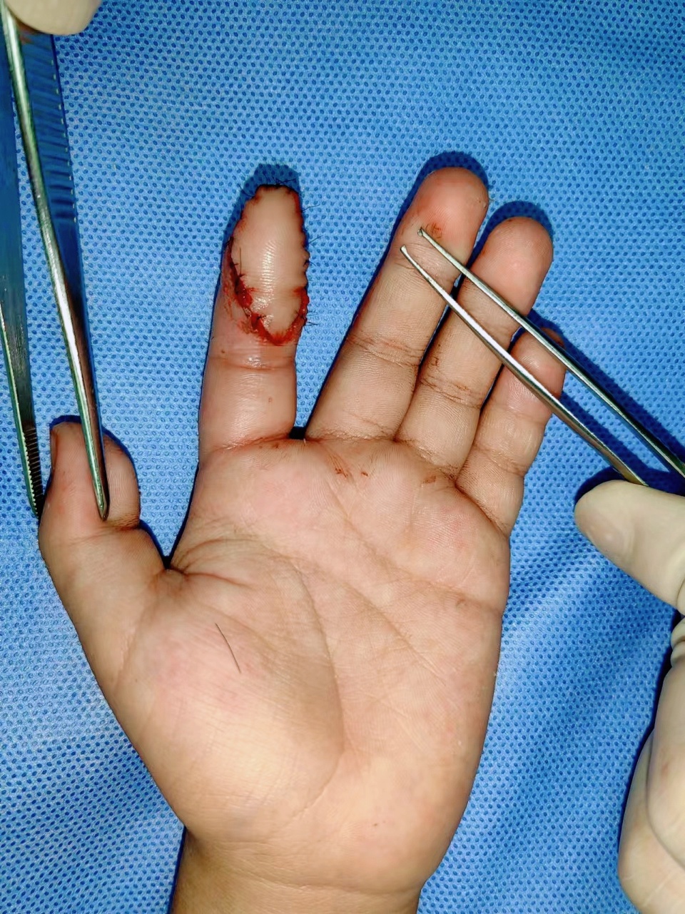 7岁男孩将食指伸进电扇被削掉一半,医生移花接木用脚趾补好手指
