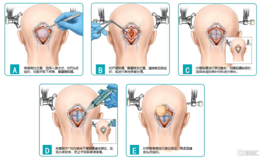 手术防粘连液怎么用赛克赛斯三闯IPO，专注于医疗器械领域，近5年累计分红3.23亿元_https://www.jmylbn.com_新闻资讯_第3张
