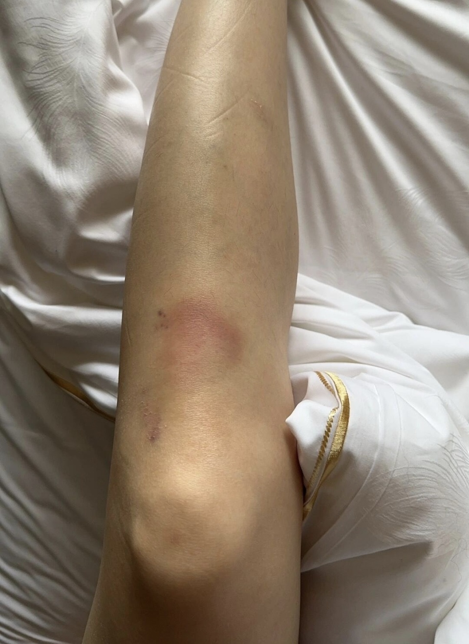 女生腿摔伤肿了的图片图片