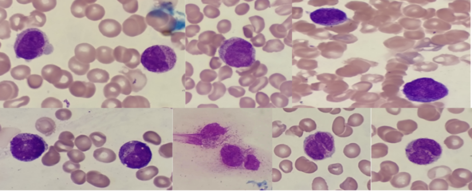 立即电话告知医生患者外周血涂片找到疑似异常早幼粒细胞,为了缩短