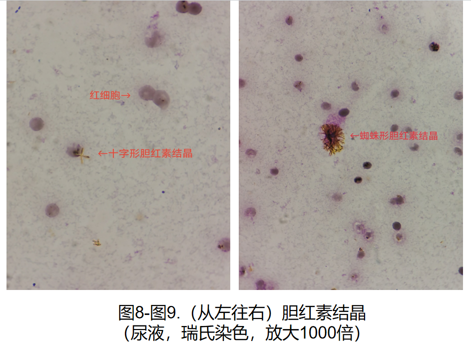 胆红素结晶图片图片