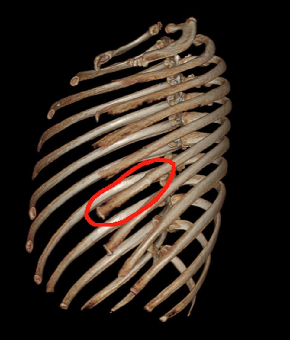 连续几天提"大包小包"拜年,武汉七旬婆婆肋骨骨折