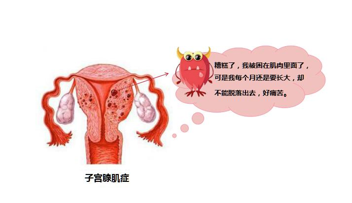 子宫腺肌症的微创介入治疗