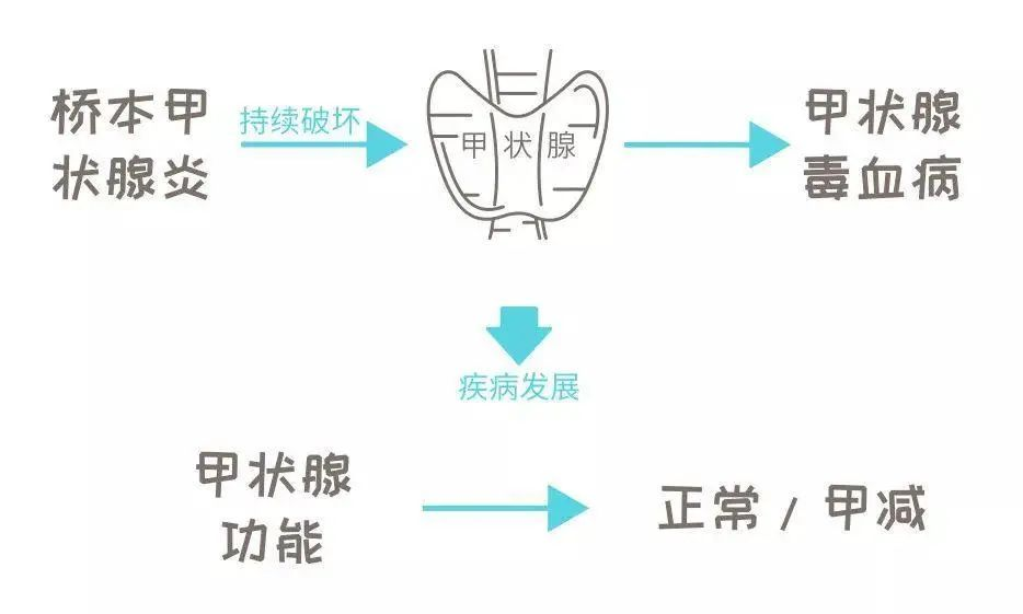 永久的甲减期此时,甲状腺功能可以表现为正常状态,出现脖子肿大,气管