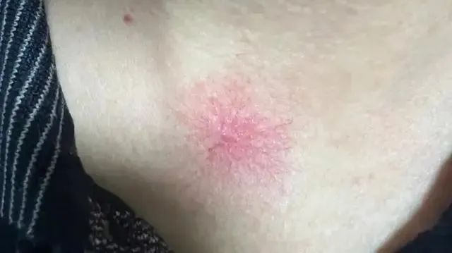 确诊肝癌!身上突然出现这种"红疹"千万别大意