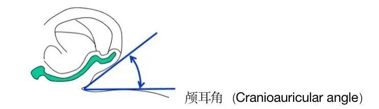 衡量的标准就是耳朵背面和颅骨的夹角,一般耳朵颅骨角为30°~45