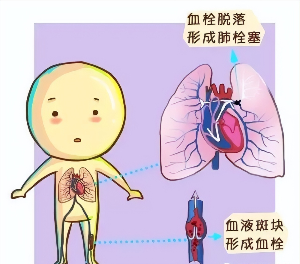 八旬老人反复咳嗽咳痰气促,背后的"隐形杀手"竟是广泛性肺栓塞