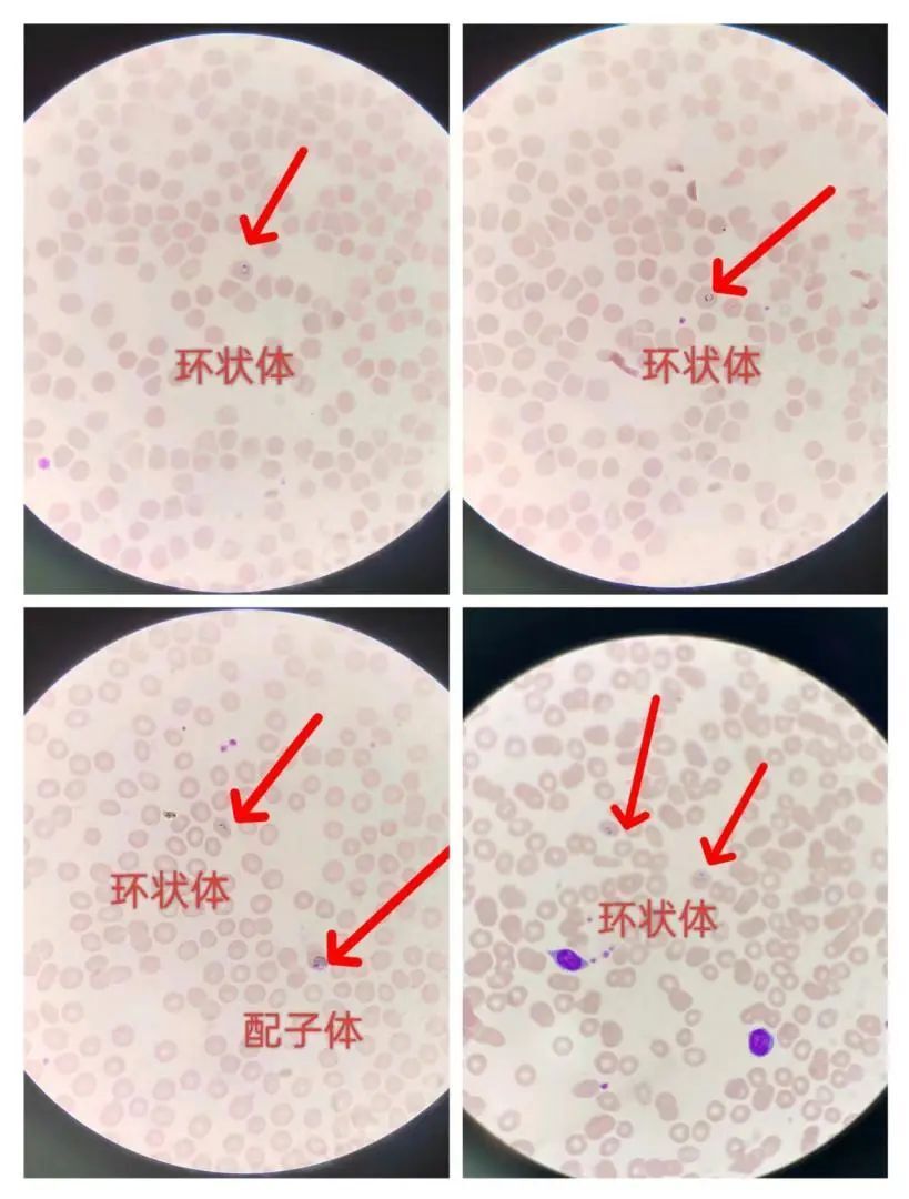 疟疾血片制作染色步骤图片