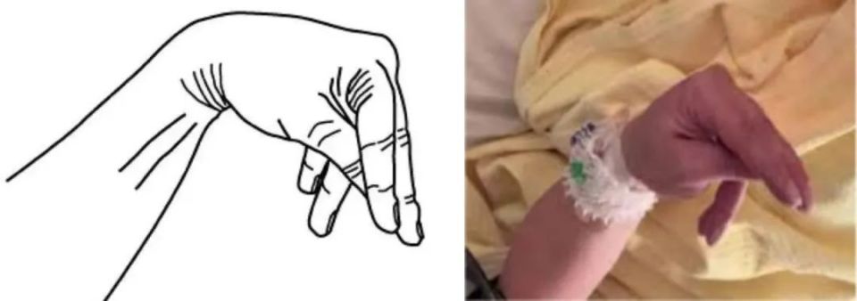 11岁孩子突发"抽搐,四肢麻木,无力",检查后竟是.