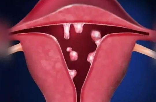 子宫肌瘤"偏爱"这4类女性,身体出现这4个信号,多半是子宫肌瘤来了