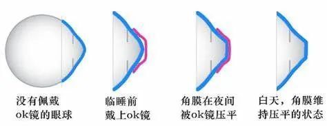 OK镜能治愈近视？别天真了！它在延缓近视发展上有用