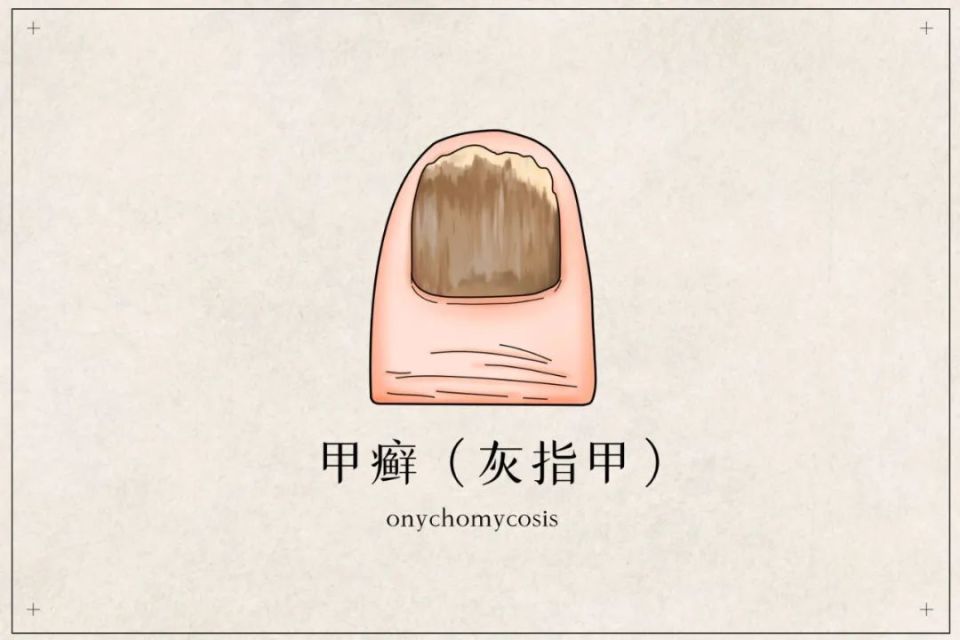 医用弹力袜用什么洗让人疼上热搜的“光腿神器”，还能穿吗？_https://www.jmylbn.com_新闻资讯_第3张