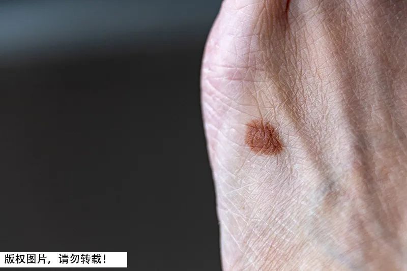 医生:死亡率非常高,尤其长在这种地方…_腾讯新闻