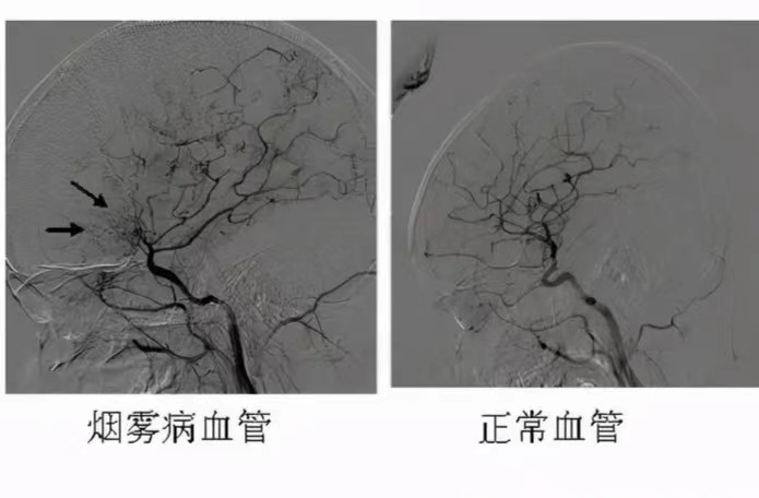 河南经验写入最新烟雾病中国专家共识