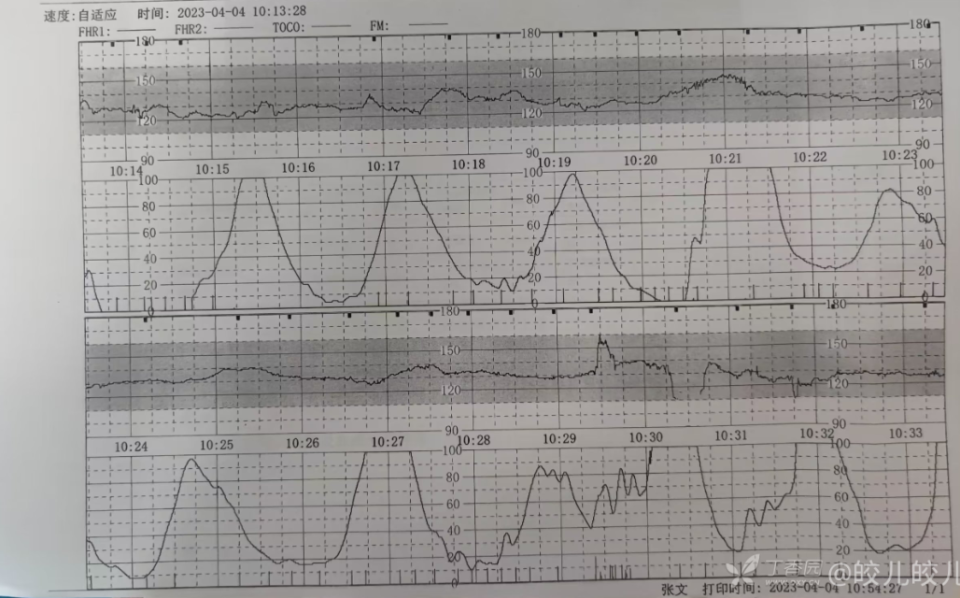 胎心监护变异减速图片