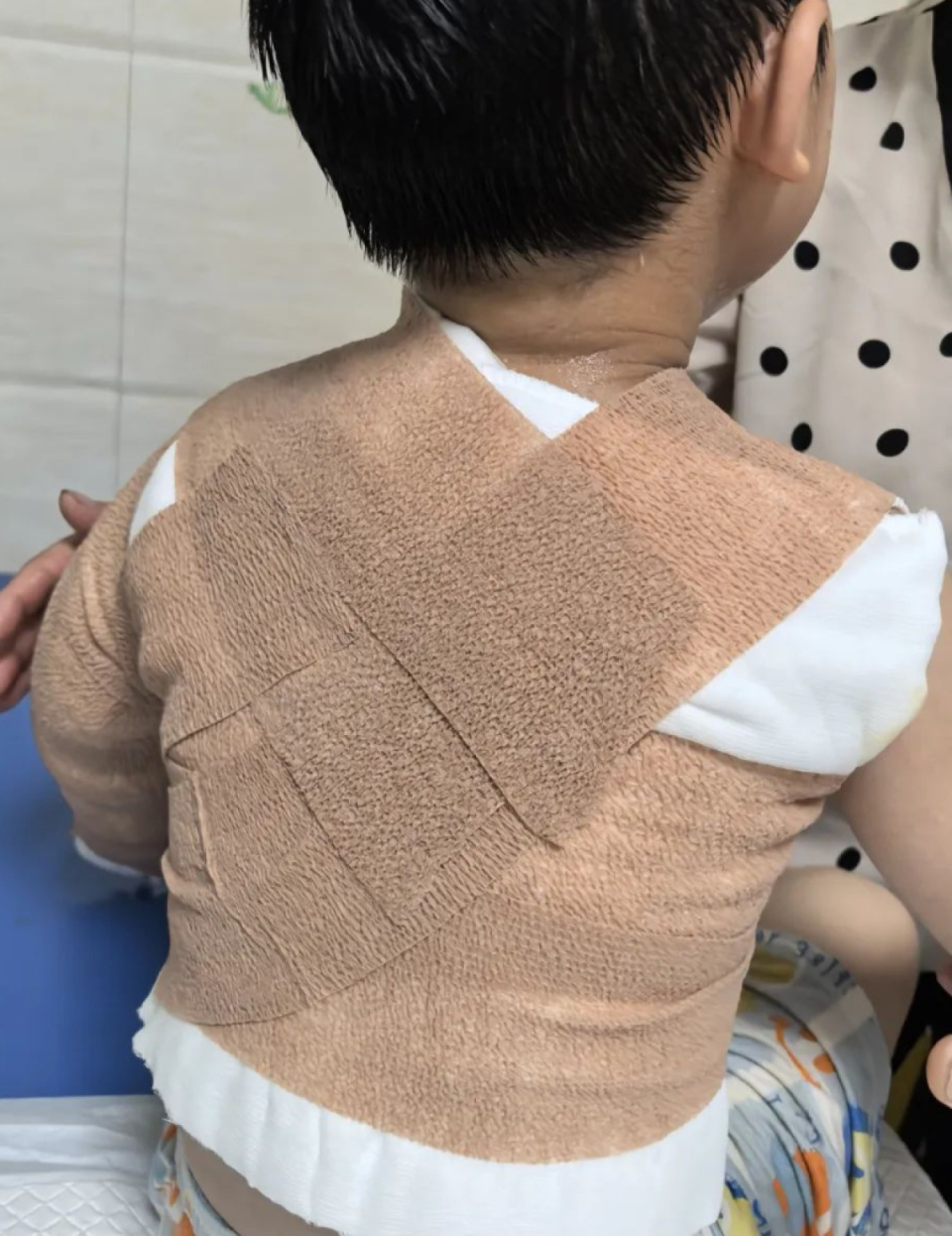 炎炎夏日儿童烫伤高发！河南省儿童医院医生
