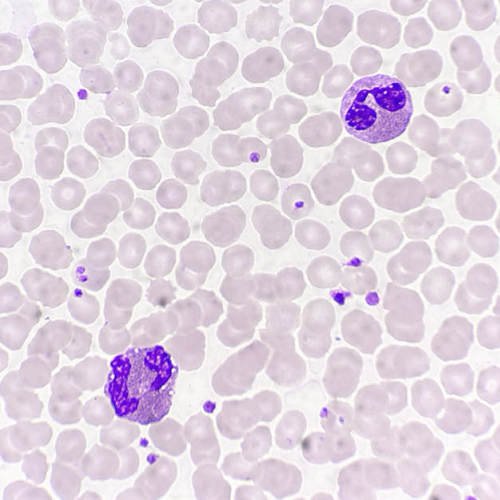 嗜酸性粒细胞增高,你遇到这种疾病么?_腾讯新闻