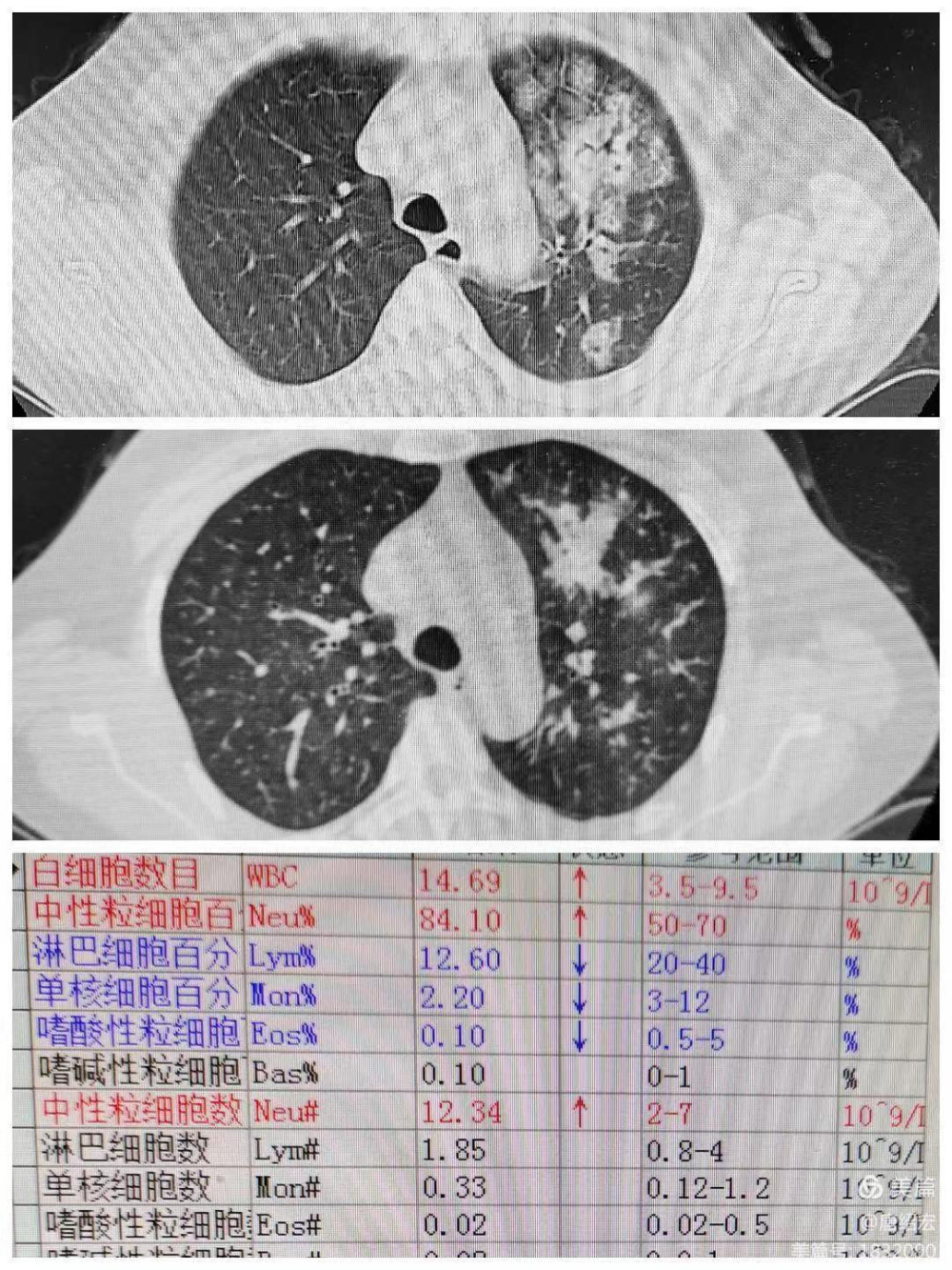 细菌性肺炎ct影像图片图片