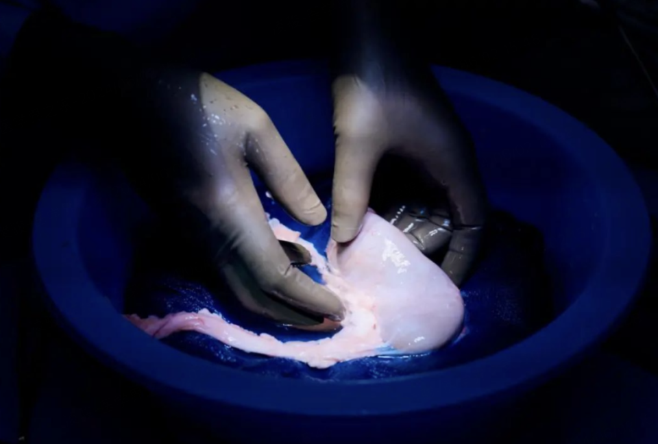 全球第2位猪肾移植患者恢复透析
