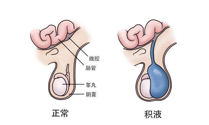 美观;另一方面积液较多张力较大时患儿可能出现阴囊坠胀等不适症状