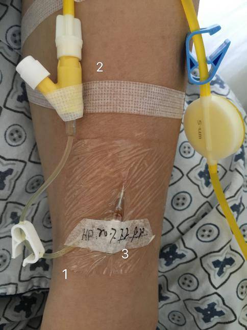 1,通过学习徐文芳在改良静脉留置针固定的效果观察并结合临床发现