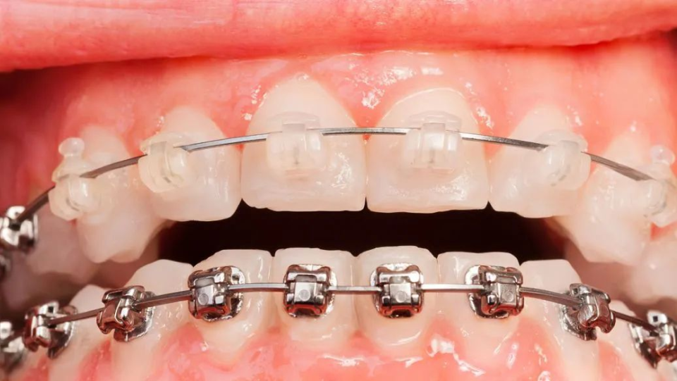 "正畸"知识知多少?什么样牙齿需要矫正_腾讯新闻