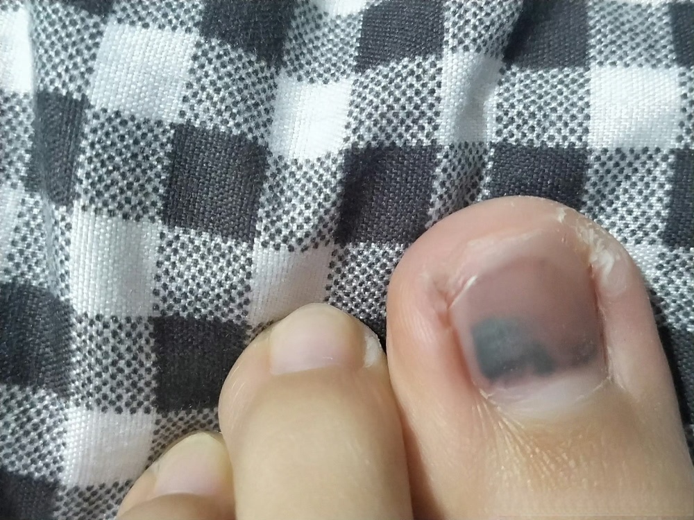 医生,我是不是得了黑色素瘤,快要死了?——一个年轻人的恐惧