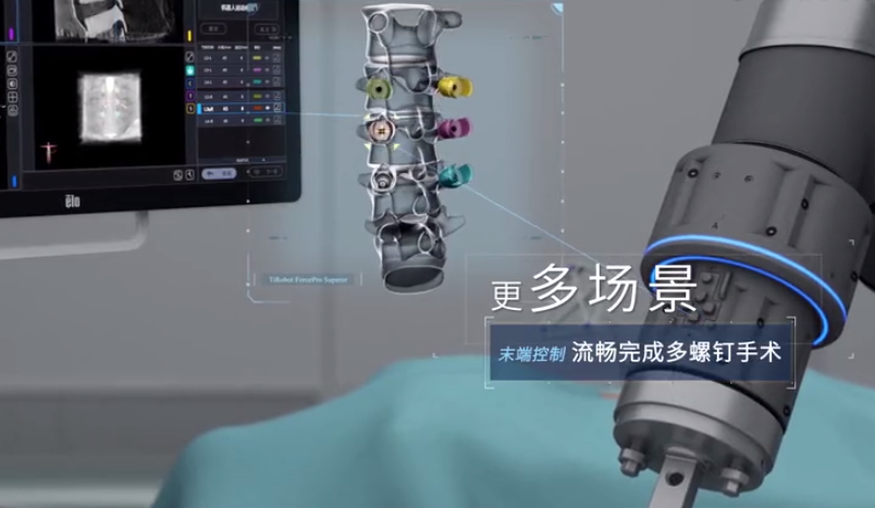 骨盆手术器械有哪些2023十大自主创新医疗器械产品_https://www.jmylbn.com_新闻资讯_第16张