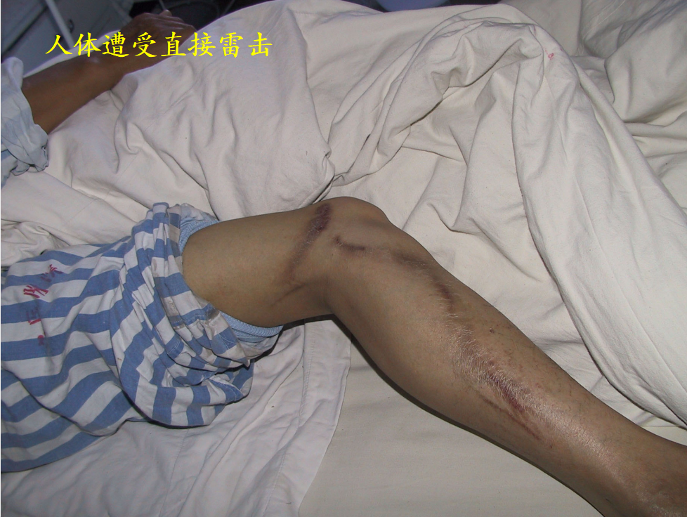 连续发生雷击事件!多人死伤!珠海气象局重要提醒