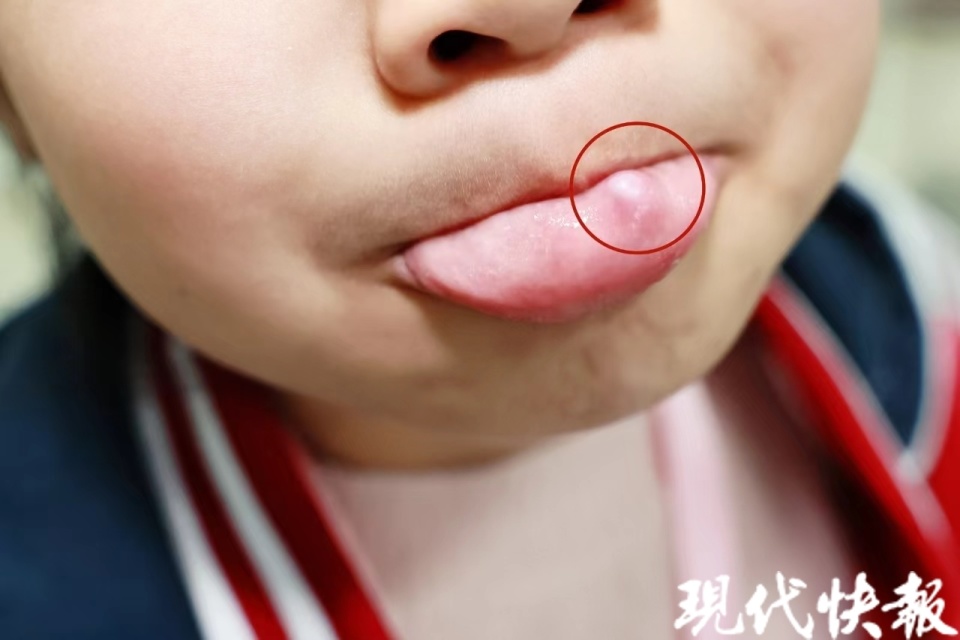 6岁女娃爱咬嘴唇嘴里长出怪东西