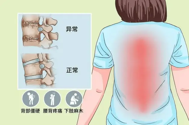 强直性脊柱炎,常见临床9个问答!