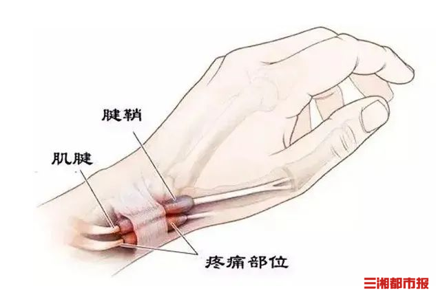 “抓大鹅”抓出腱鞘炎，别让游戏玩坏你的手