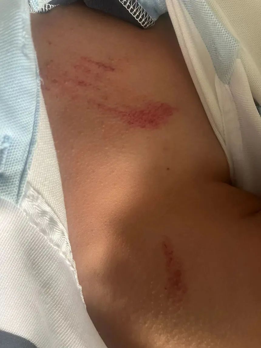 厦门一中学生被同学在厕所殴打致小腿粉碎性骨折 家长质疑学校事件