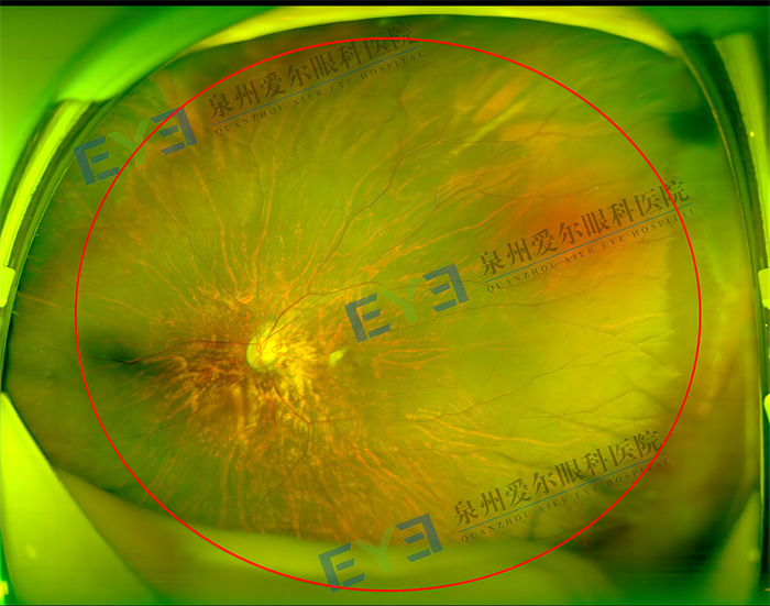 6岁男孩左眼眼轴超26mm多学科专家联合会诊帮其打补丁