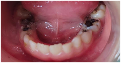 细心的人会发现,现在身边的儿童一张口,经常能看到牙齿不是黑了烂了