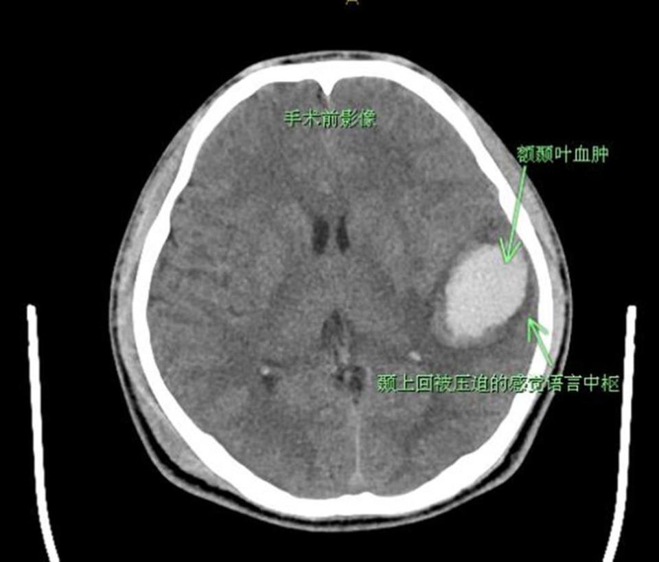 颞叶钩回疝ct图片图片