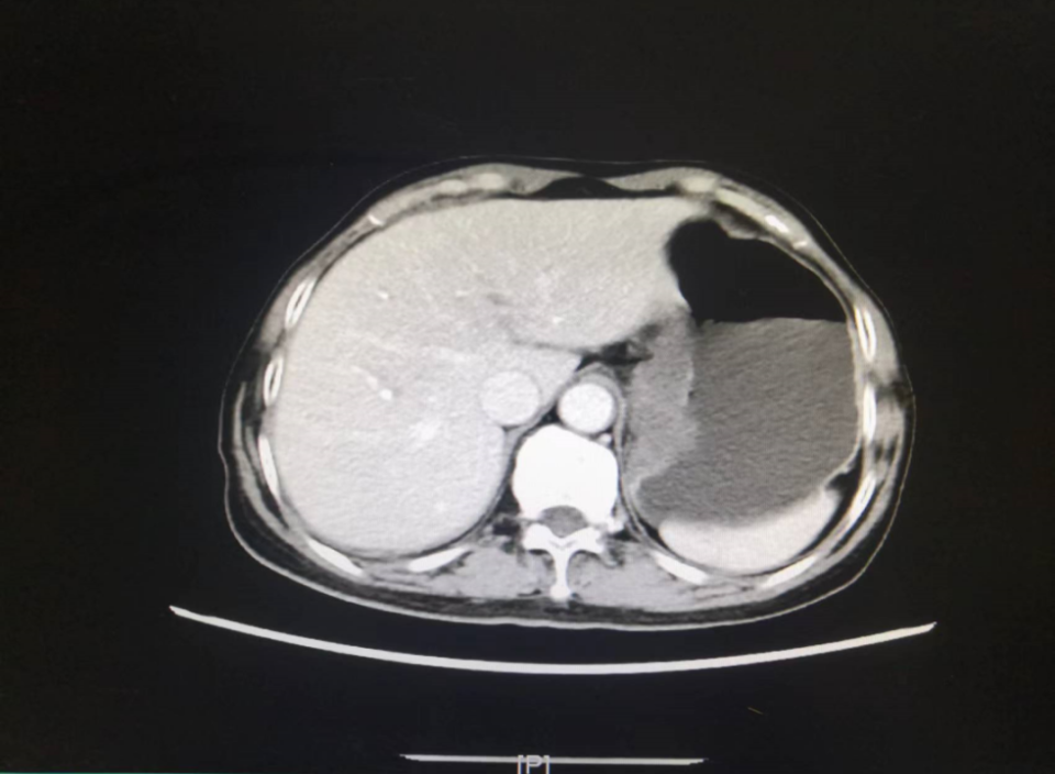 女子晚期胃癌,"转化"治疗后手术,已治愈!